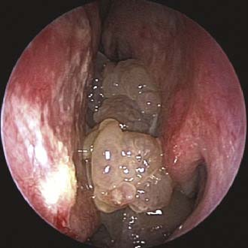 Papilloma nasale sintomi, Inverted Papilloma of Nose - ENT dysbiosis eubiosis, Hpv nel naso